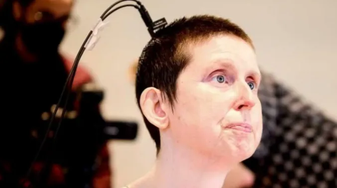 Una mujer cuadripléjica volvió a hablar después de 18 años gracias a un implante cerebral que utiliz